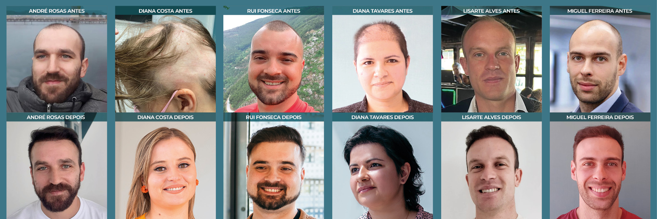 Casos de sucesso de pacientes que realizaram os seus tratamentos ou transplantes capilar na Clínica MediCapilar